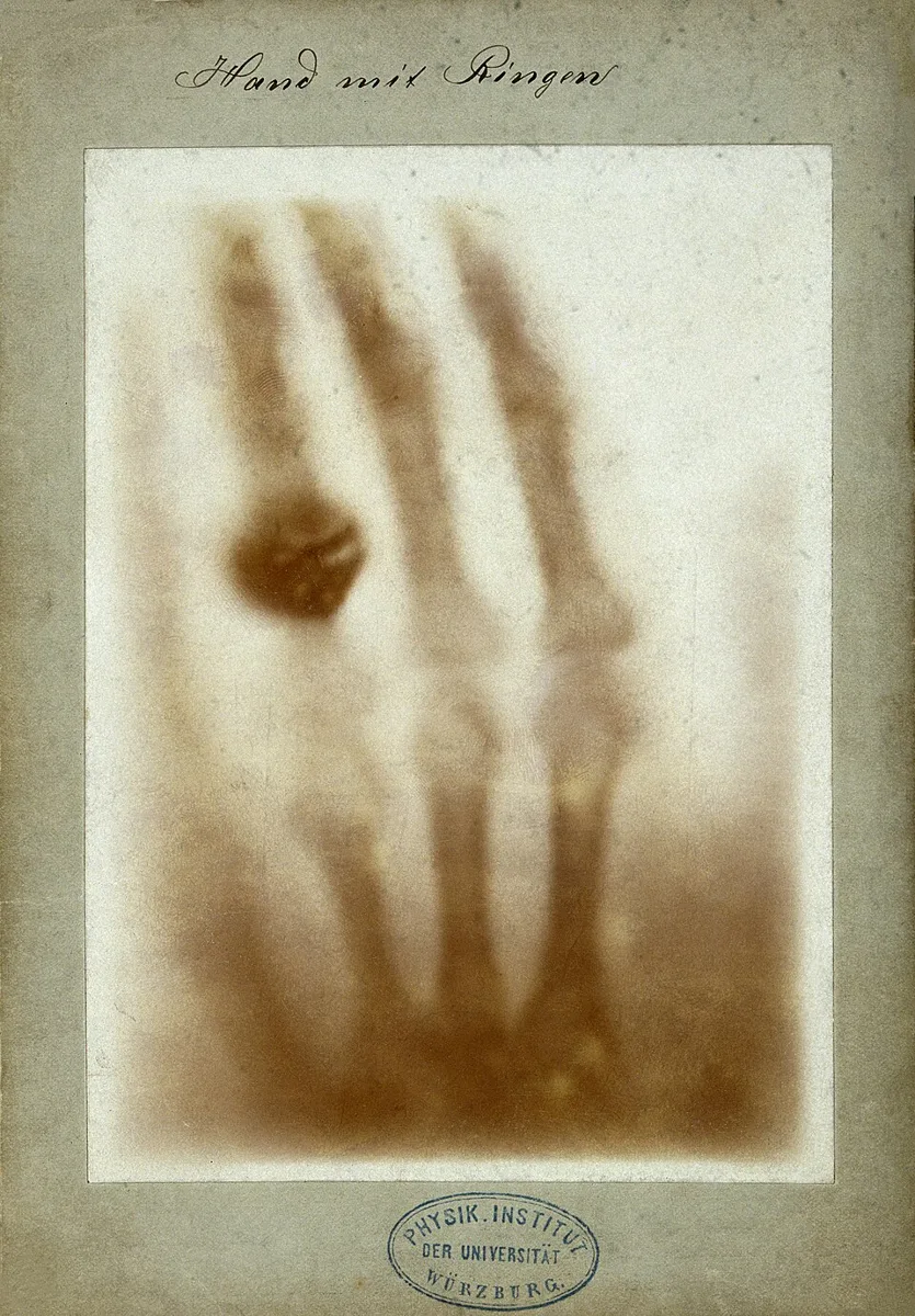 X-Ray Radiograph